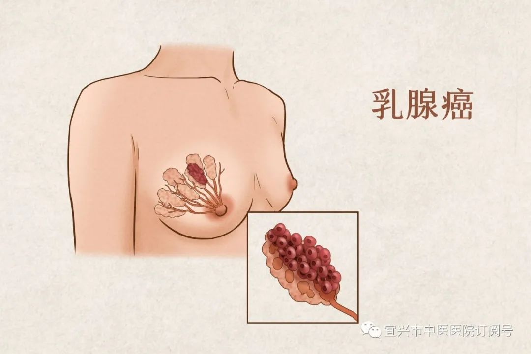 乳腺复查背后的意外发现，姐妹情深